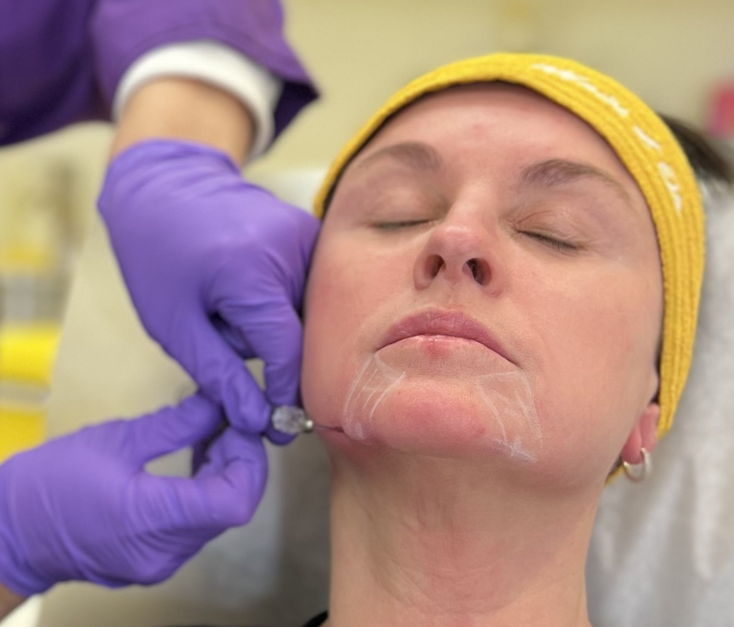 Formation en injection d'acide hyaluronique (Niveau 4)